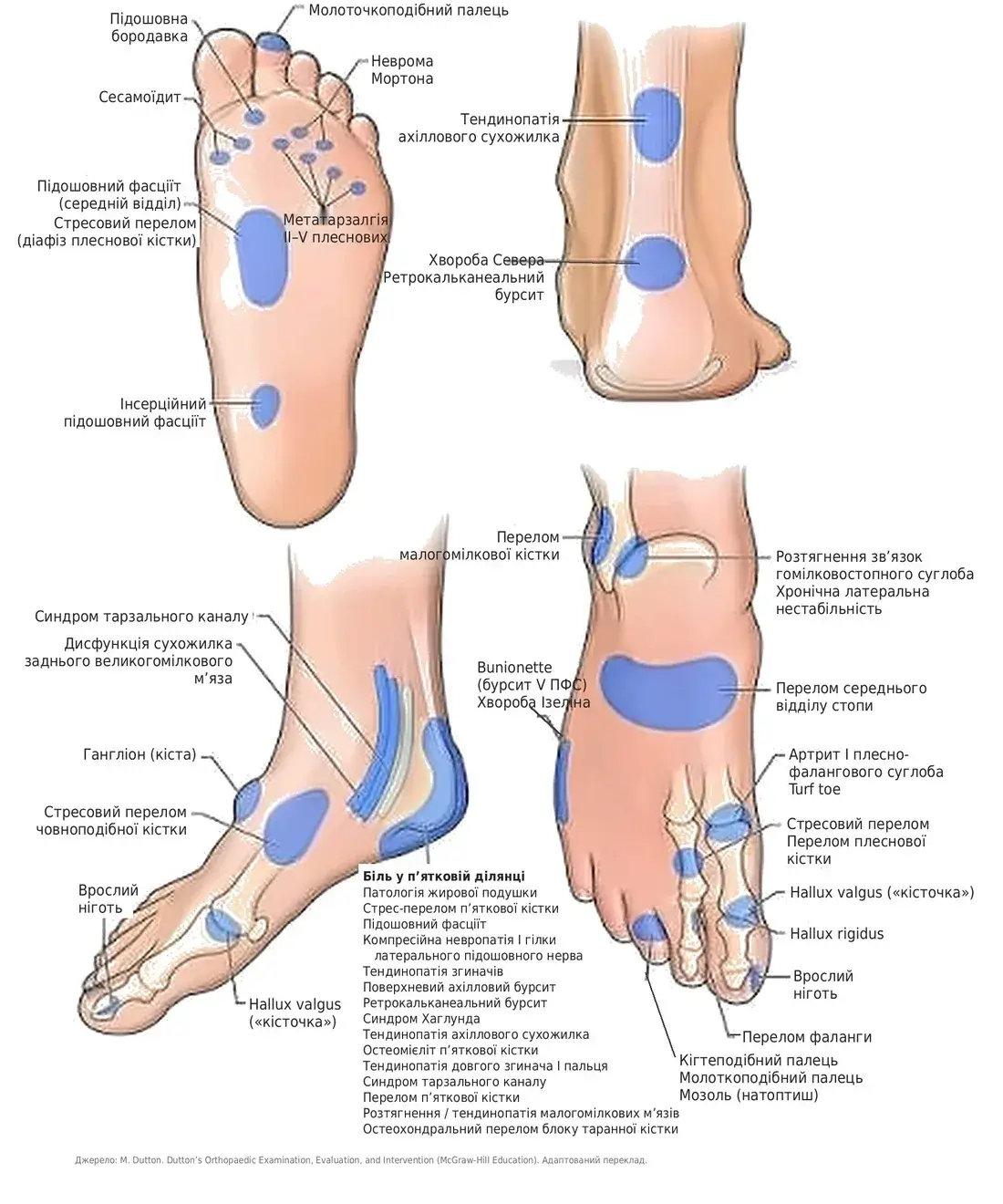 Карта больових зон стопи: hallux valgus, метатарзалгія, hallux rigidus, деформації пальців