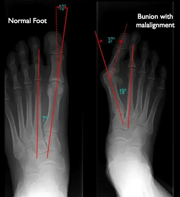 Рентген стопи з навантаженням: порівняння норми і hallux valgus із вимірюванням кутів HVA та IMA