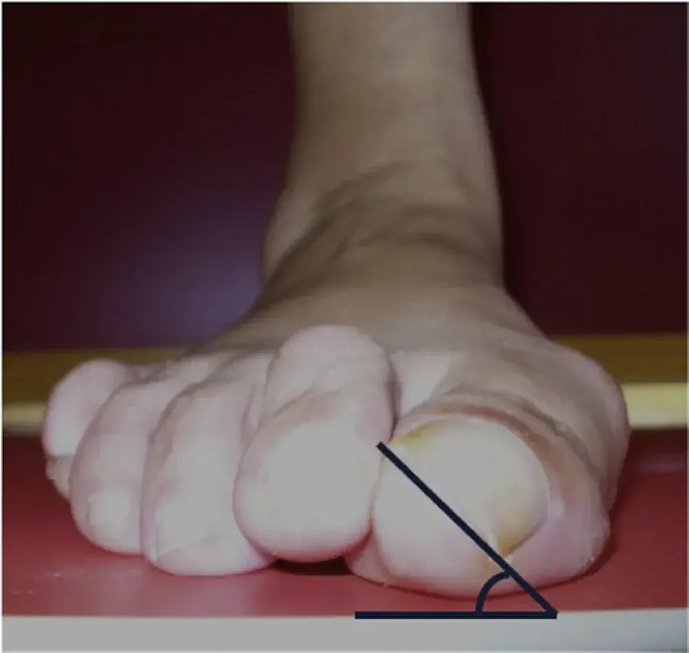Пронація великого пальця при hallux valgus: ніготь повернутий досередини, кут повороту показаний лінією