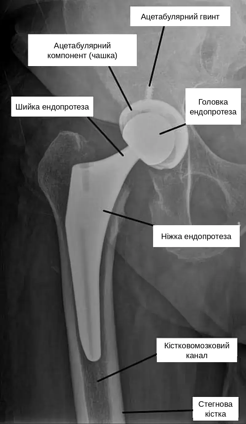 Рентгенограма встановленого ендопротеза кульшового суглоба з підписами компонентів
