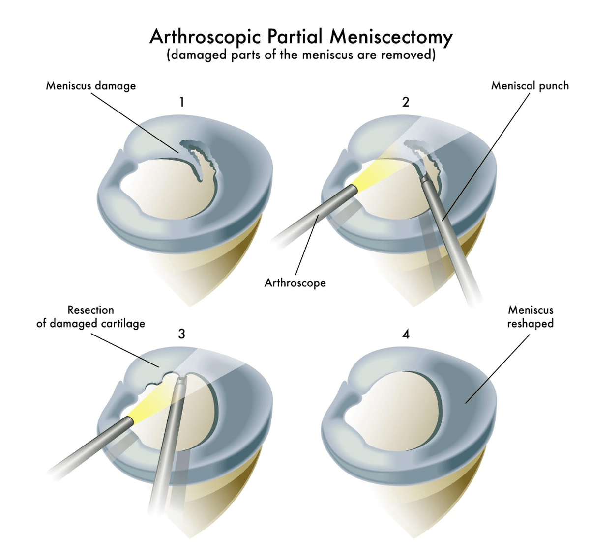 Хірургічне лікування розриву меніска
