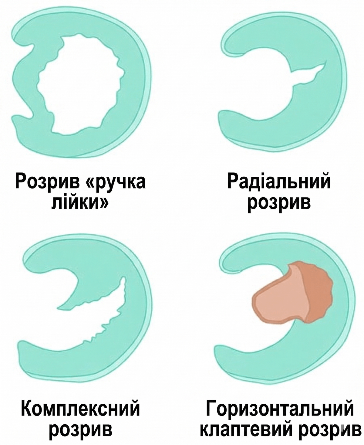 Вигляд пошкодженого меніска та типові зони болю