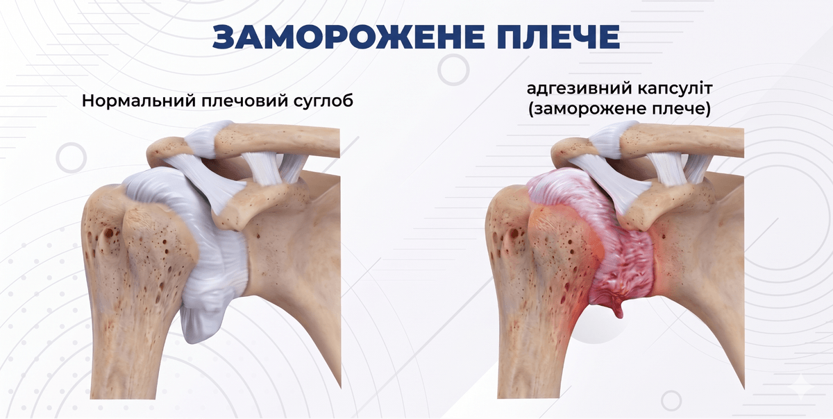 Анатомія плечового суглоба при адгезивному капсуліті
